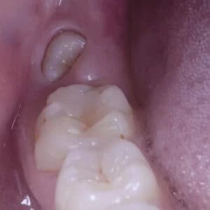 Implante dental y corona