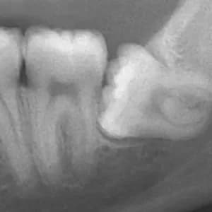 Corte 3D de implante dentario