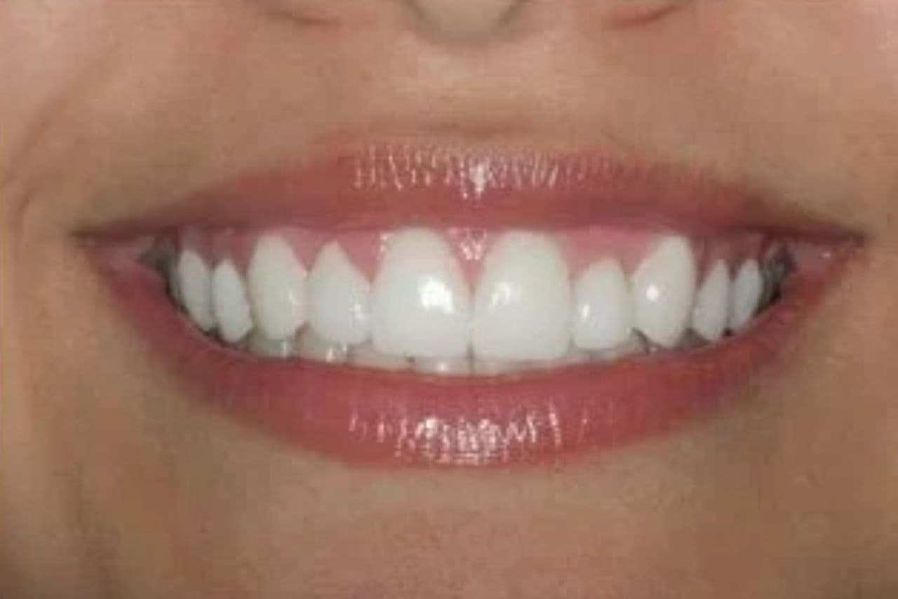 Después de carillas