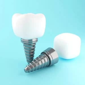 Implante dental y corona