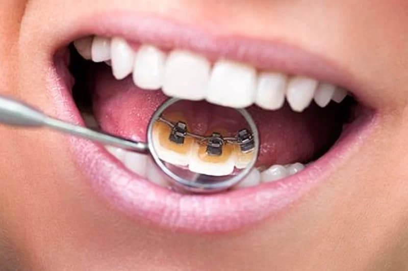 Brackets linguales con espejo dental
