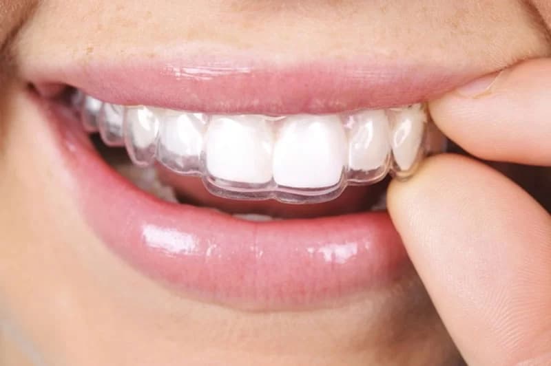 Alineador transparente colocado sobre los dientes