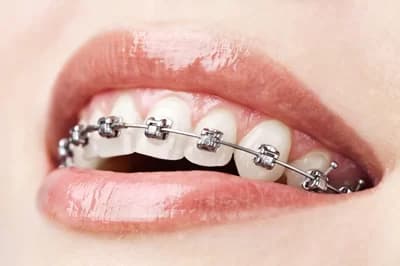 Brackets metálicos convencionales en dientes anteriores
