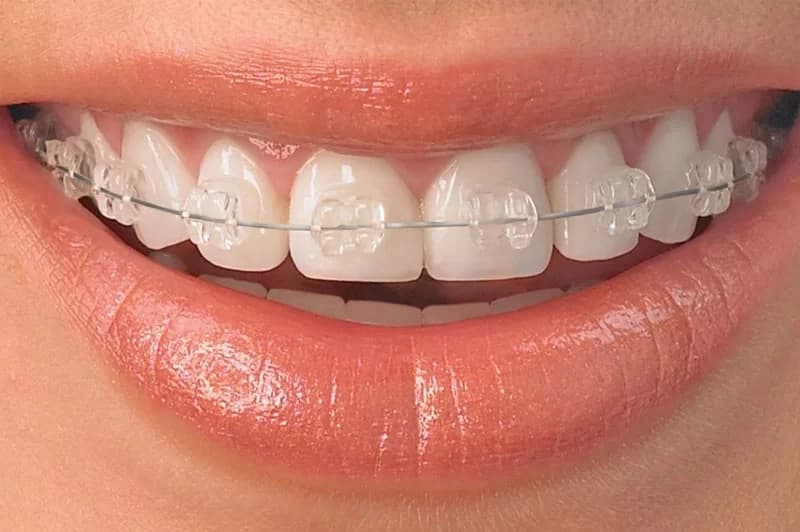 Brackets estéticos transparentes detallados