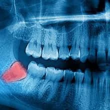 Corte 3D de implante dentario