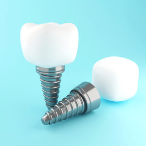 3D Illustration. Dental tooth implant. Dental care concept.